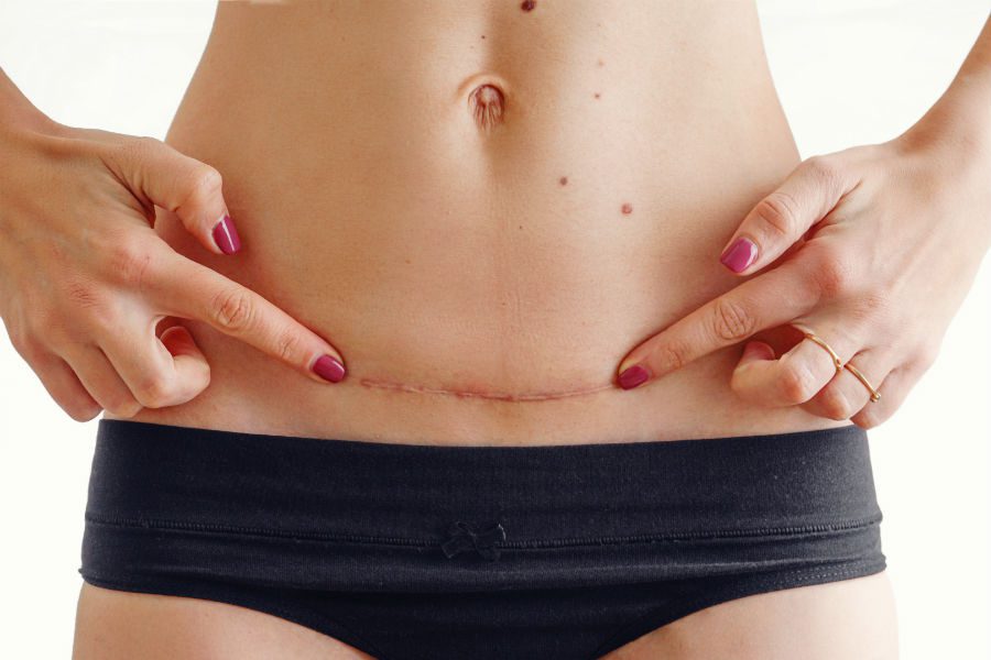 Cinta Pós-Parto: Afinal, pode ou não pode usar? 2 Cicatriz de parto cesariano