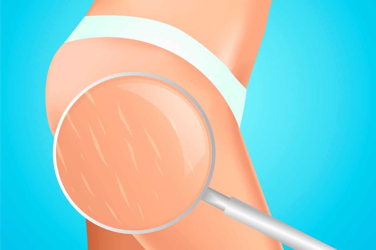 Tratamentos para estrias: 10 opções para suavizar as marcas 3 tratamentos para estrias