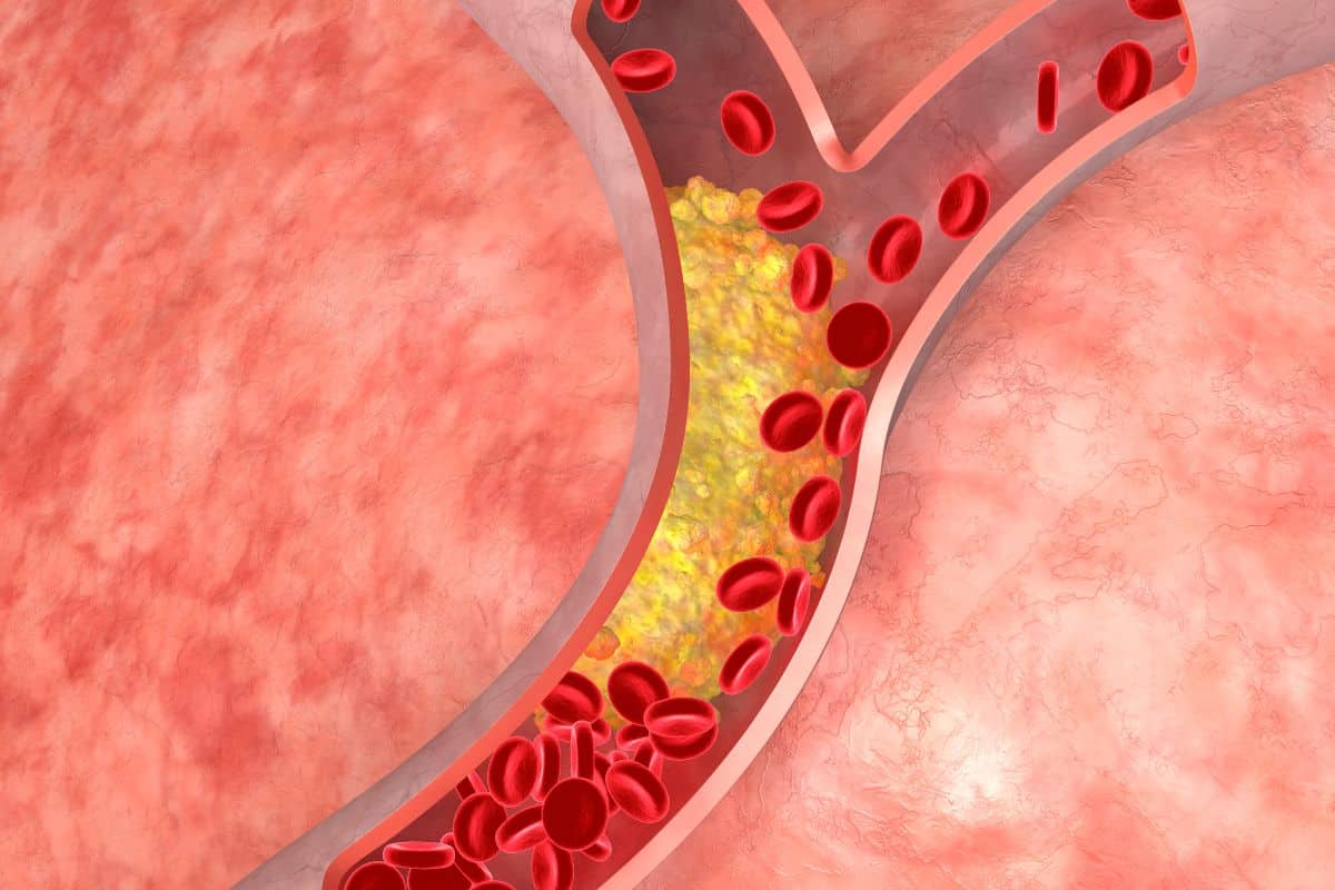 O que colesterol alto pode causar no corpo? Saiba como derrotar esse vilão 2 Descubra o que o colesterol alto pode causar no corpo