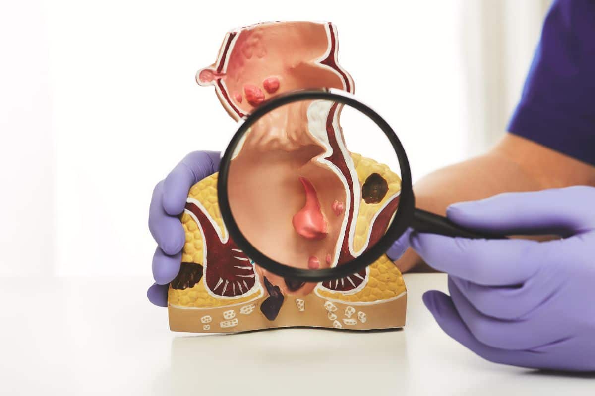O que causa hemorroida? Aprenda em poucos minutos tudo que você precisa saber para evitar 2 médico mostra o que causa hemorroida