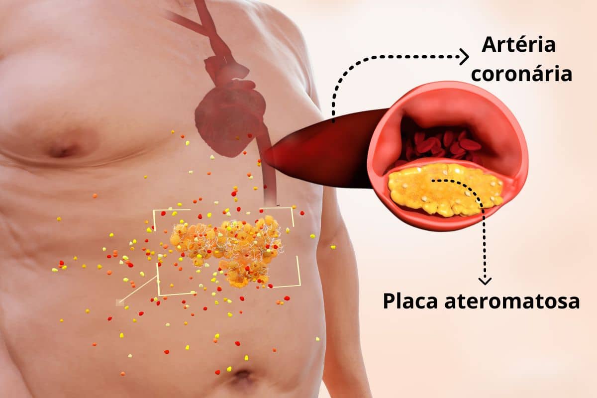 O que é angina? Entenda hoje os riscos e como evitar a doença 2 artéria coronária mostrando o que é angina