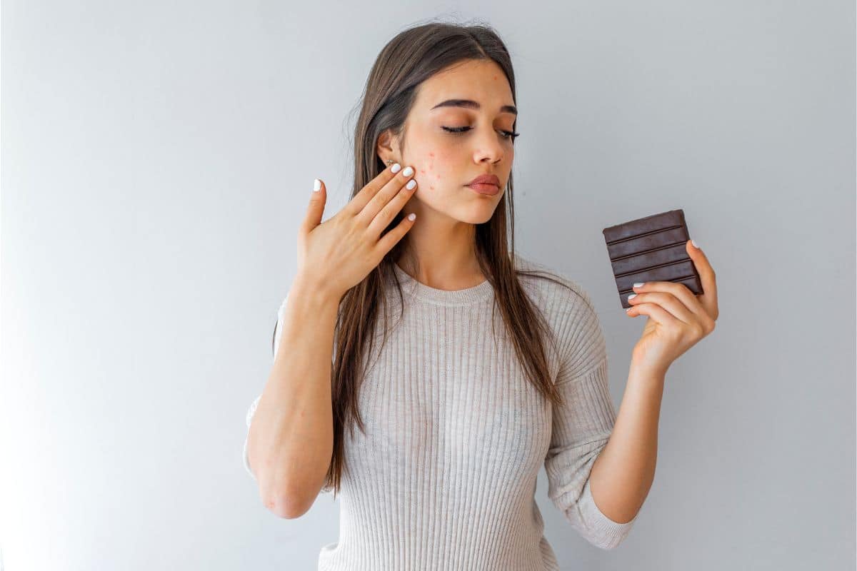 Por que exagerar no chocolate pode causar acne? Entenda os riscos para a sua pele 1 comer chocolate pode causar acne