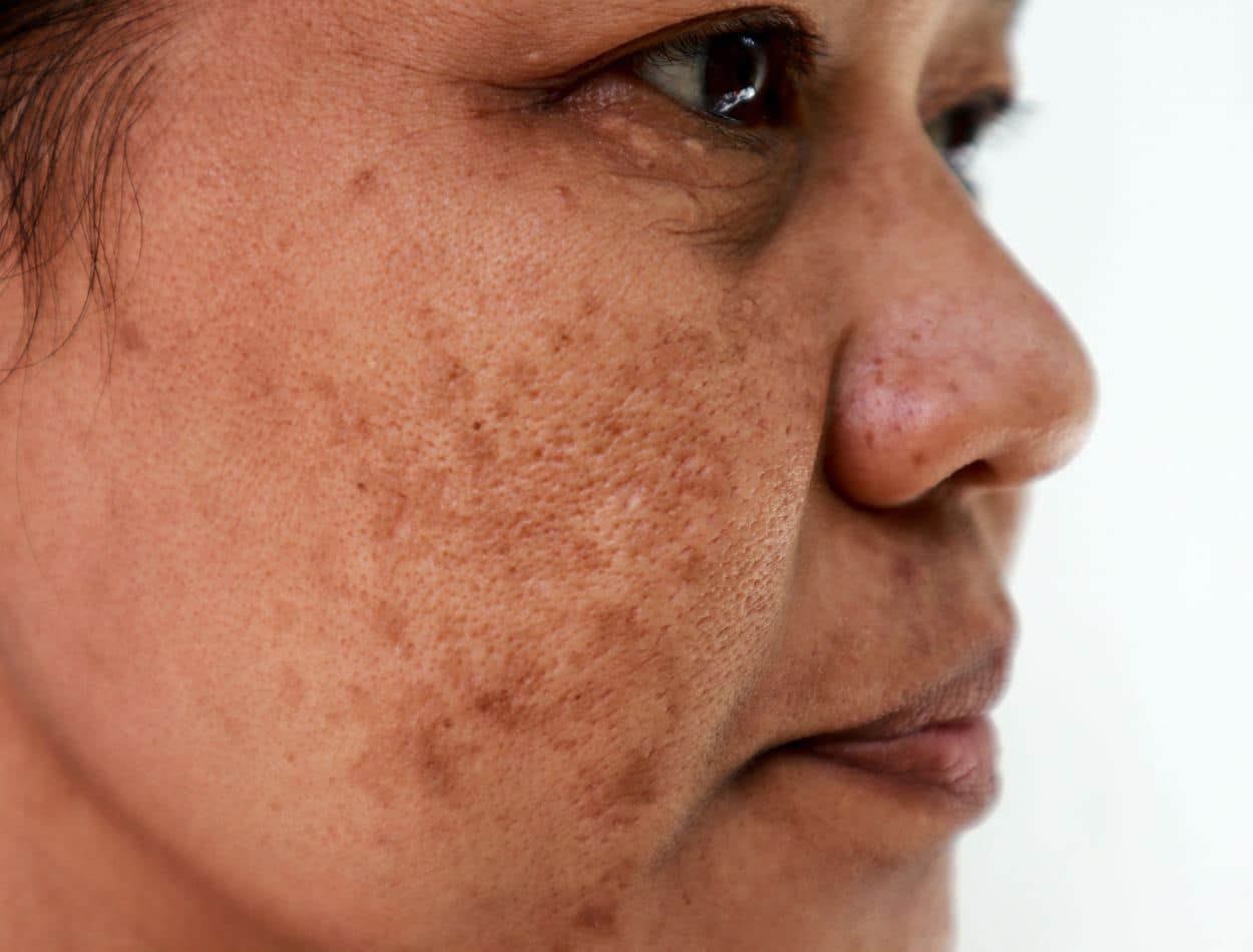 5 erros comuns ao usar filtro solar que podem afetar sua pele e você não sabe 1 pele manchada pelo sol em excesso