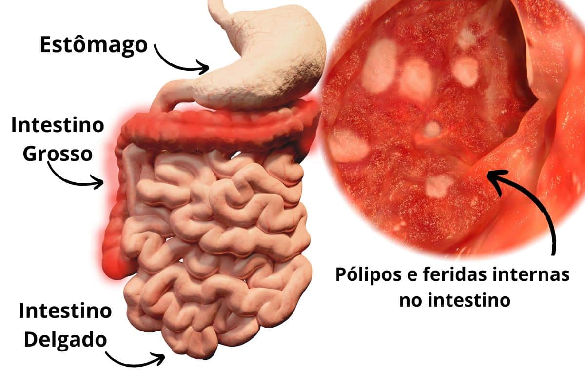 Para que serve o exame de colonoscopia? Conheça os detalhes e sua importância 2 imagens de exame de colonoscopia