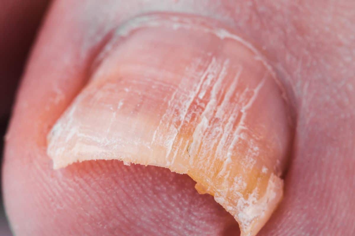 Você sabe se micose nas unhas é transmissível? Como evitar? Saiba a verdade hoje 1 micose nas unhas é transmissível
