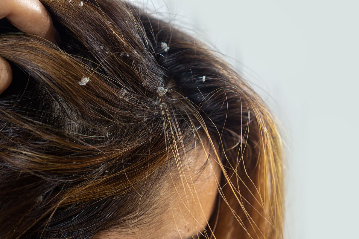 O que causa caspa? Como tratar? Mitos e verdades que você precisa saber 2 caspas no cabelo