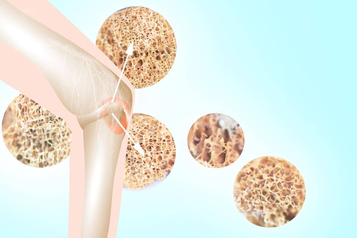 O que causa osteoporose? Saiba o que fazer para deter o avanço dessa doença 2 imagem de osso com osteoporose