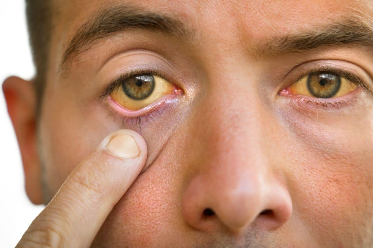 Primeiros sintomas de gordura no fígado: entenda as causas 1 primeiros sinais de gordura no fígado homem com branco dos olhos amarelados