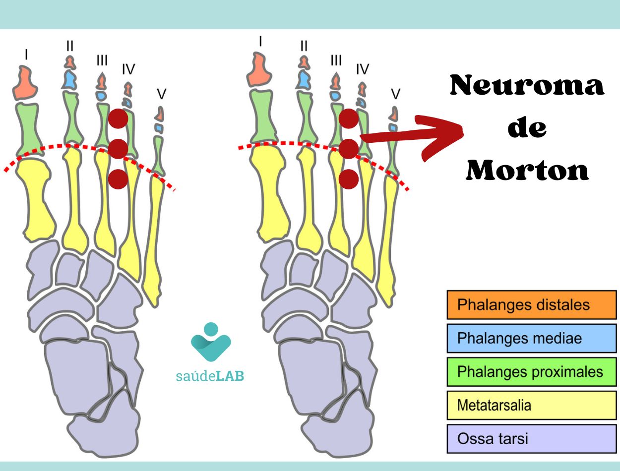 Neuroma de Morton: sapatos apertados ou com bico fino podem causar tumores nos pés 2 Neuroma de Morton