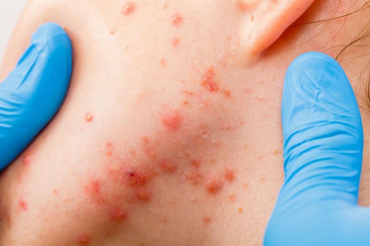 Quando suspeitar de puberdade precoce? É importante ficar atento aos sinais 1 acne na puberdade precoce