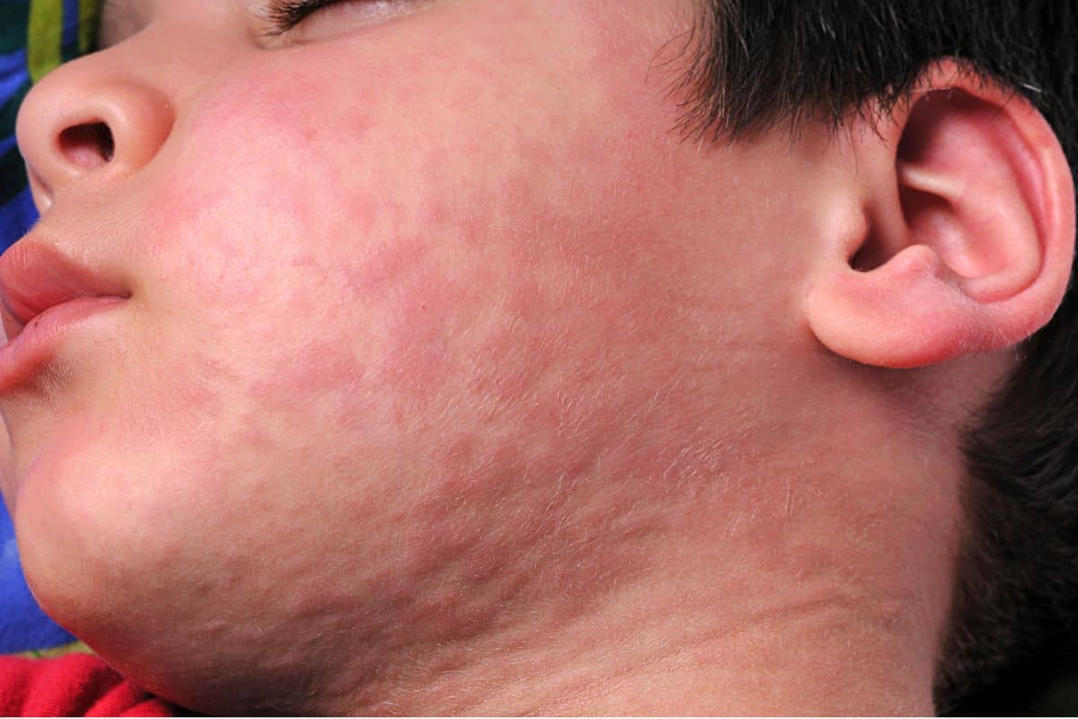 5 sintomas da alergia alimentar: saiba os mais comuns para agir rapidamente 3 sintomas de alergia alimentar