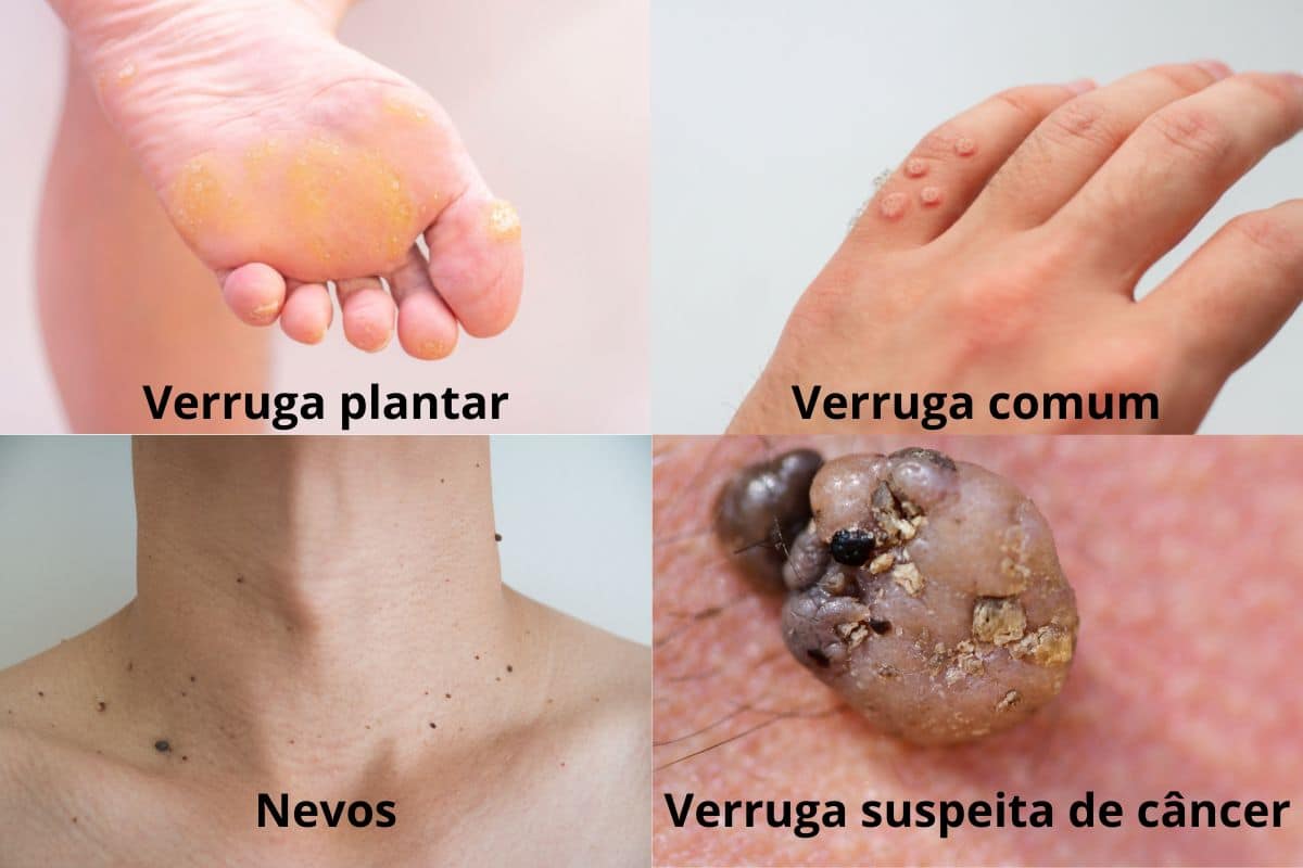 Quando as verrugas são perigosas? Por que elas surgem? Quais os tipos? Entenda já 2 tipos de verrugas