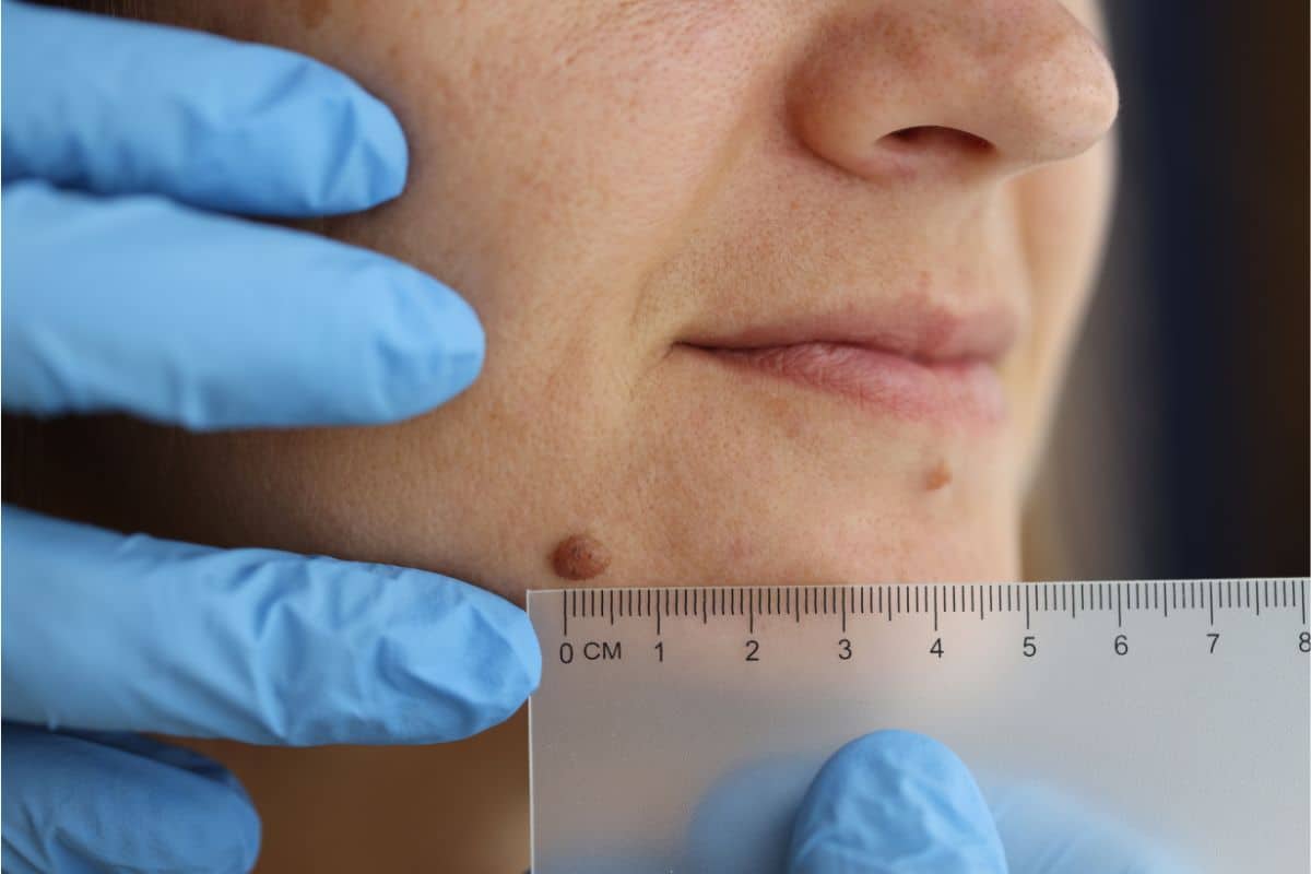 Quando as verrugas são perigosas? Por que elas surgem? Quais os tipos? Entenda já 1 avaliação médica de verrugas