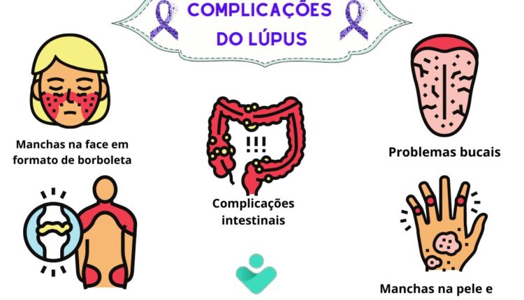 O que provoca lúpus, a doença de Astrid Fontanelle? Entenda as principais causas e veja como se cuidar 2 lúpus complicações