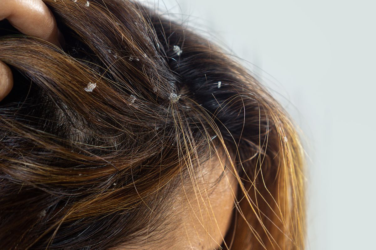O que causa seborreia? Como eliminar? Confira soluções possíveis 1 O que causa a dermatite seborreica
