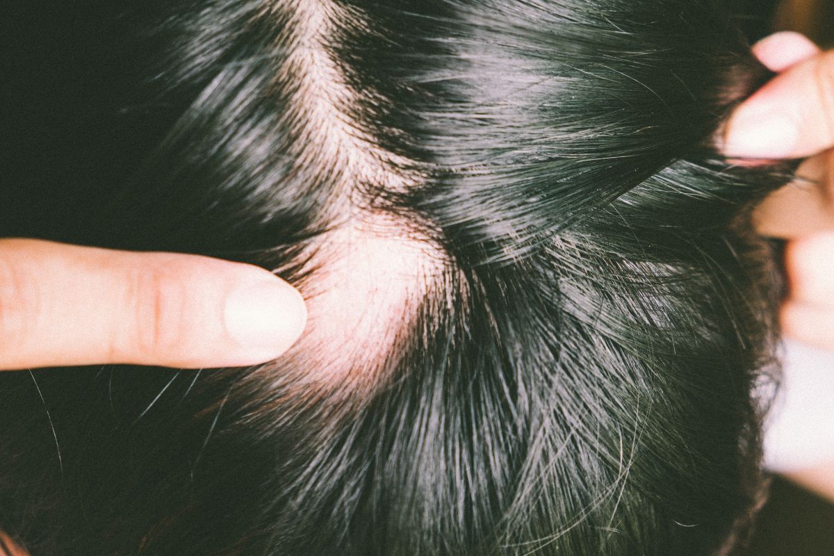 Maraísa, da dupla com Maiara, revelou ter Alopecia; entenda a condição e se tem cura 2 O que é alopecia areata