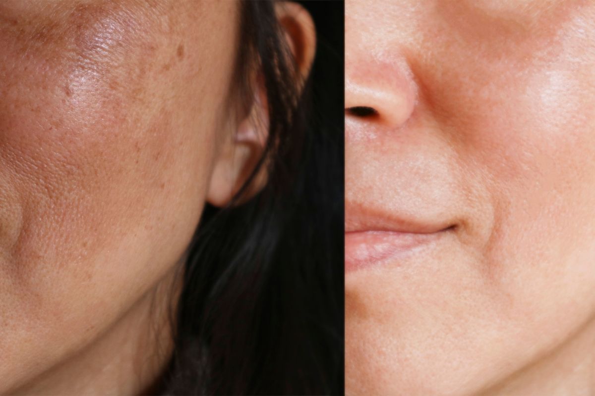 O que é melasma? Quais as causas comuns? Entenda 2 O que é melasma