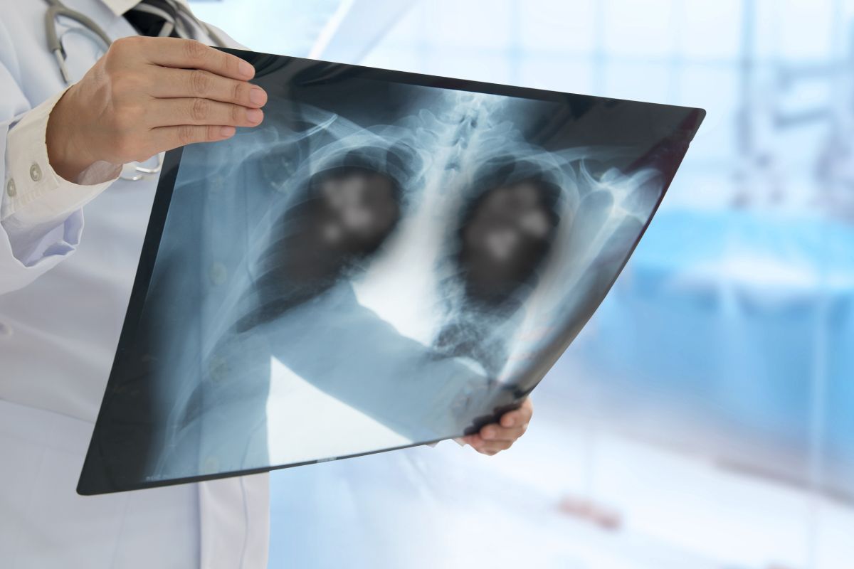 Quais os sintomas de pneumonia? Entenda todos os sinais do problema respiratório 2 Quais os sintomas de pneumonia