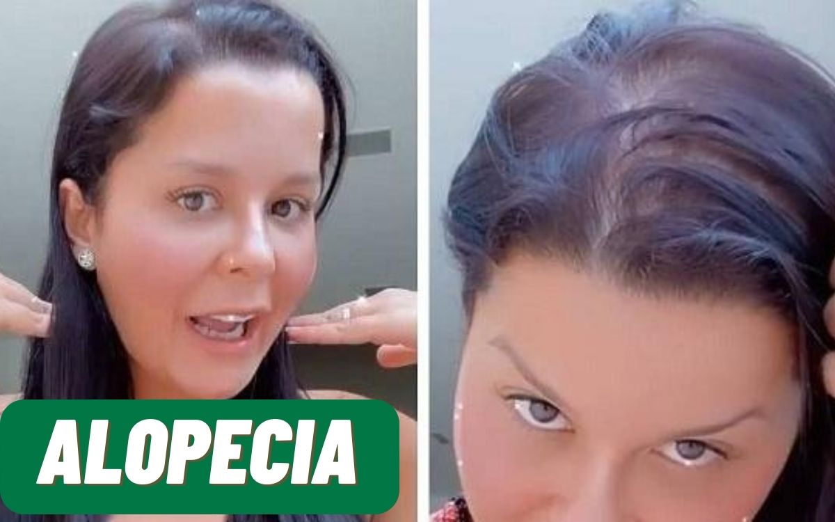 Maraísa, da dupla com Maiara, revelou ter Alopecia; entenda a condição e se tem cura 1 Maraisa com alopecia