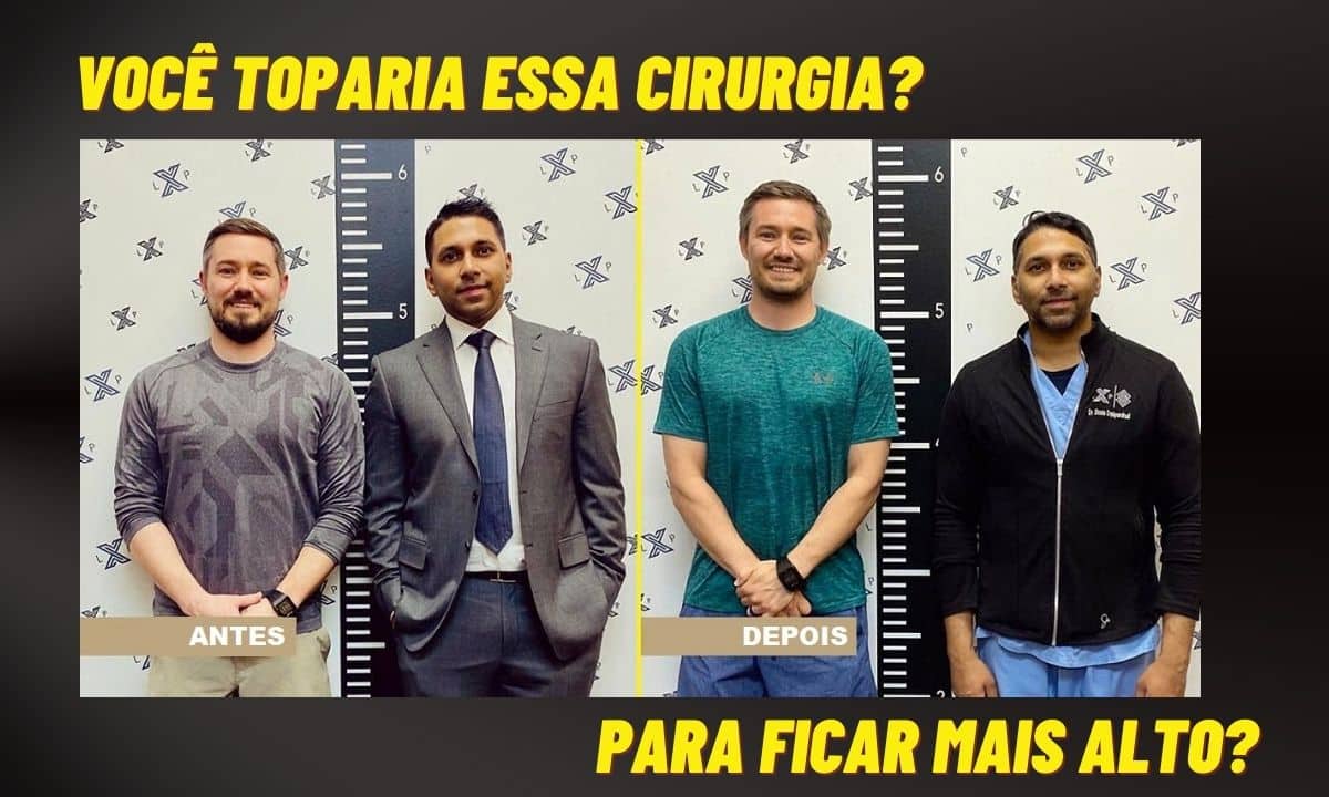 Você toparia? Cirurgia para aumento de altura faz sucesso na China 1 Cirurgia para aumento de altura