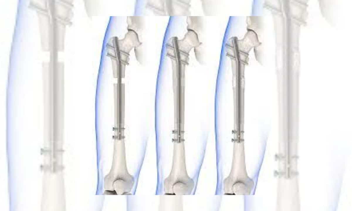 Você toparia? Cirurgia para aumento de altura faz sucesso na China 2 Você toparia? Cirurgia para aumento de altura faz sucesso na China