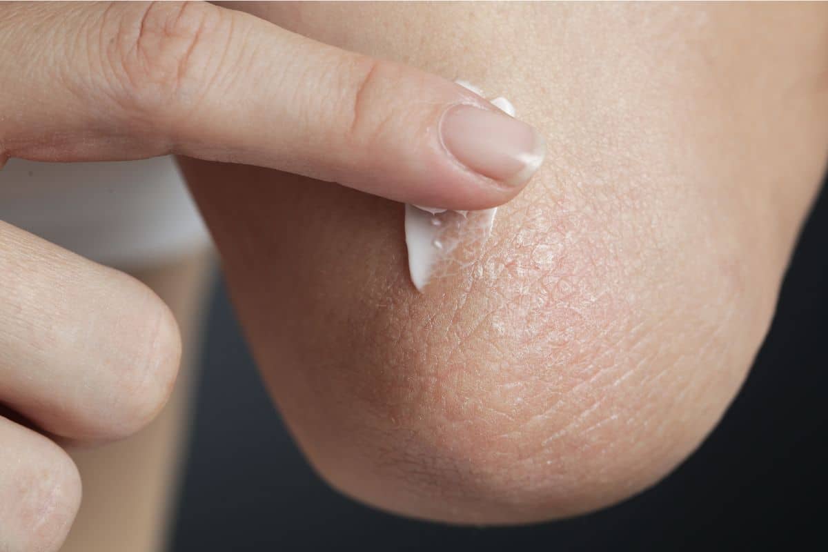 Como fazer para clarear os cotovelos? Veja dicas e melhore a aparência 1 clarear os cotovelos com creme