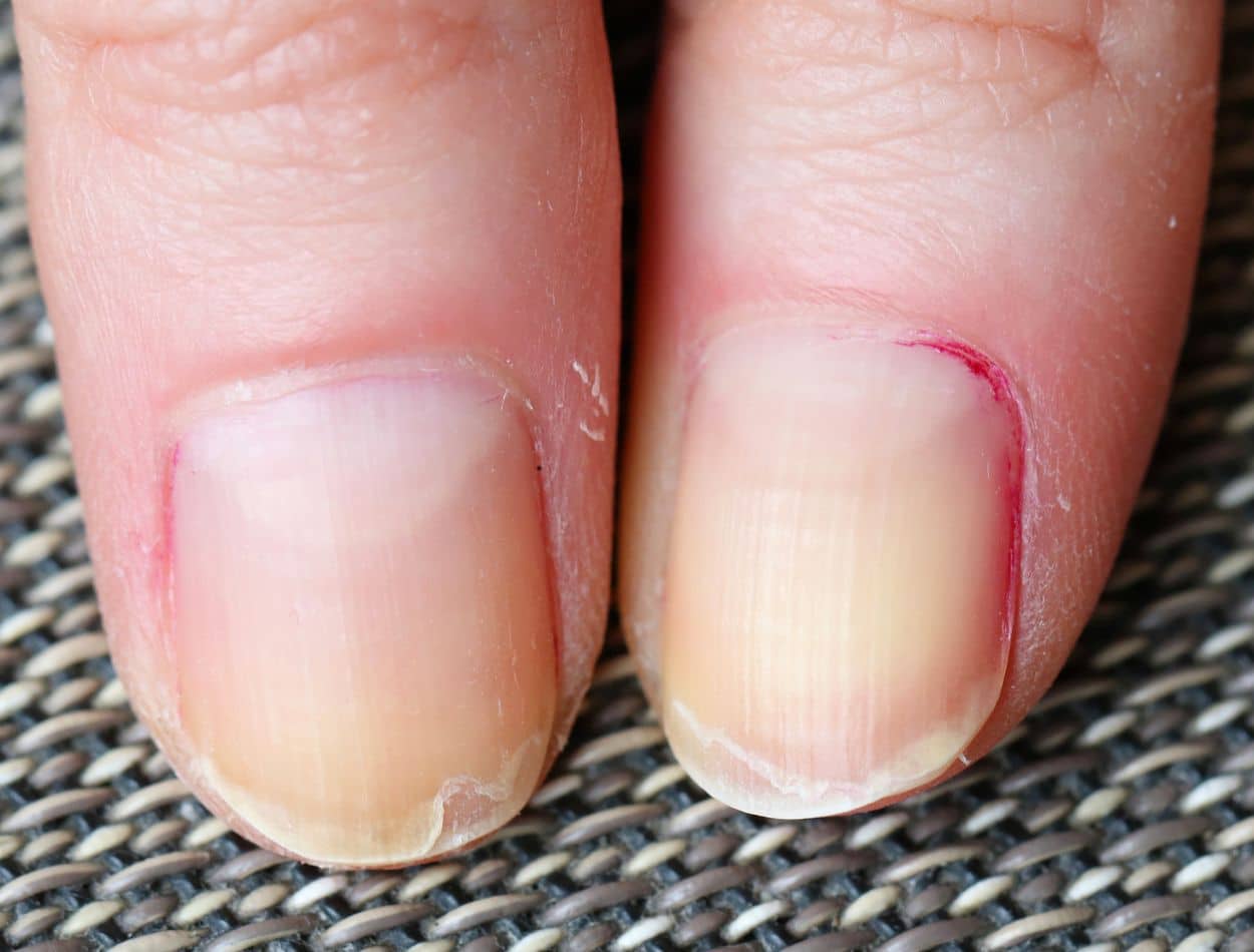 O que as linhas verticais nas unhas podem significar? 2 O que as linhas verticais nas unhas podem significar?