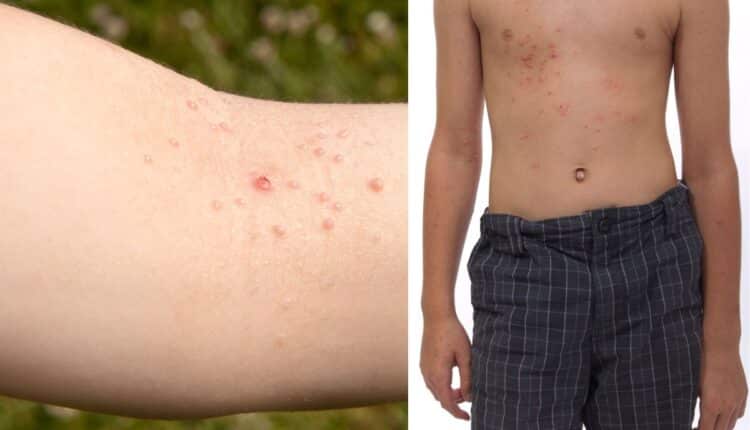 O que é molusco de pele? É contagioso? Tem tratamento e cura? 2 molusco de pele no braço e abdome