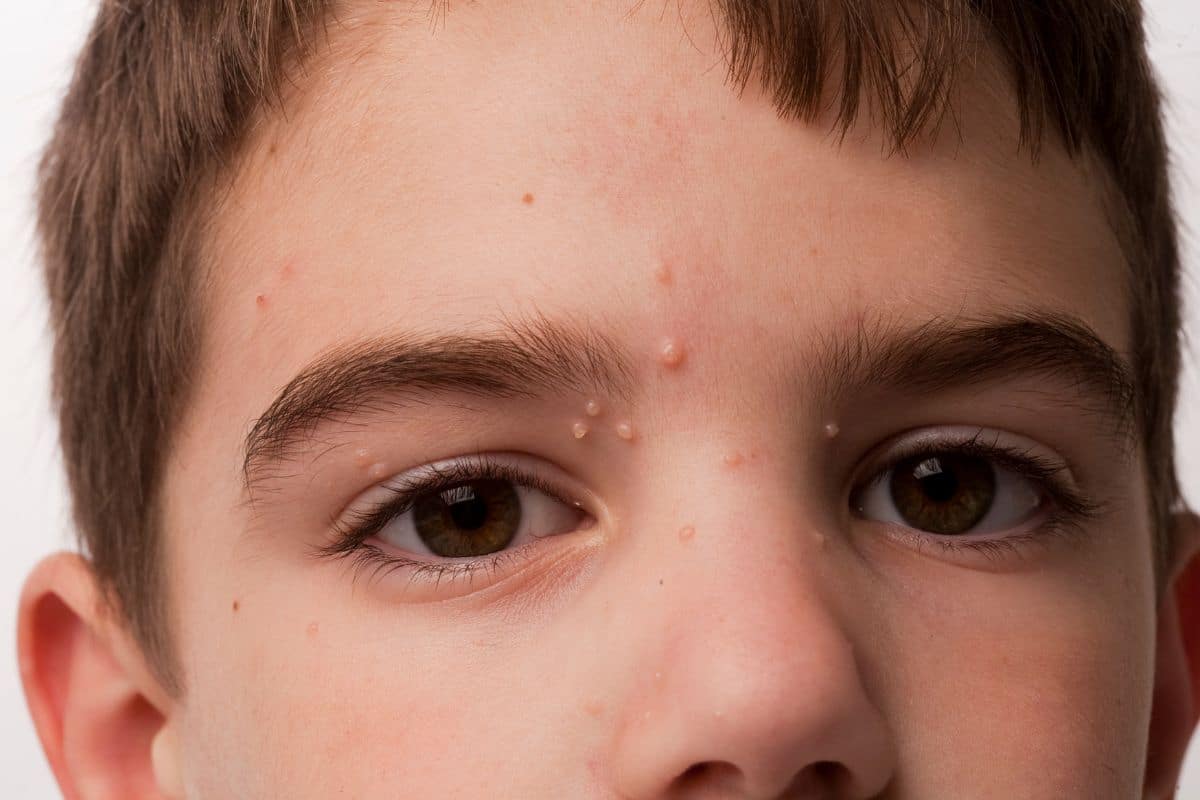 O que é molusco de pele? É contagioso? Tem tratamento e cura? 1 criança com molusco de pele no rosto