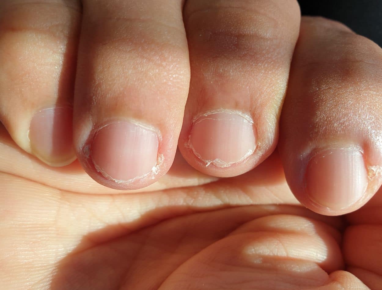 Pelinhas nas unhas e onicofose: o que causa e como evitar que apareçam 1 Pelinhas nas unhas e onicofose