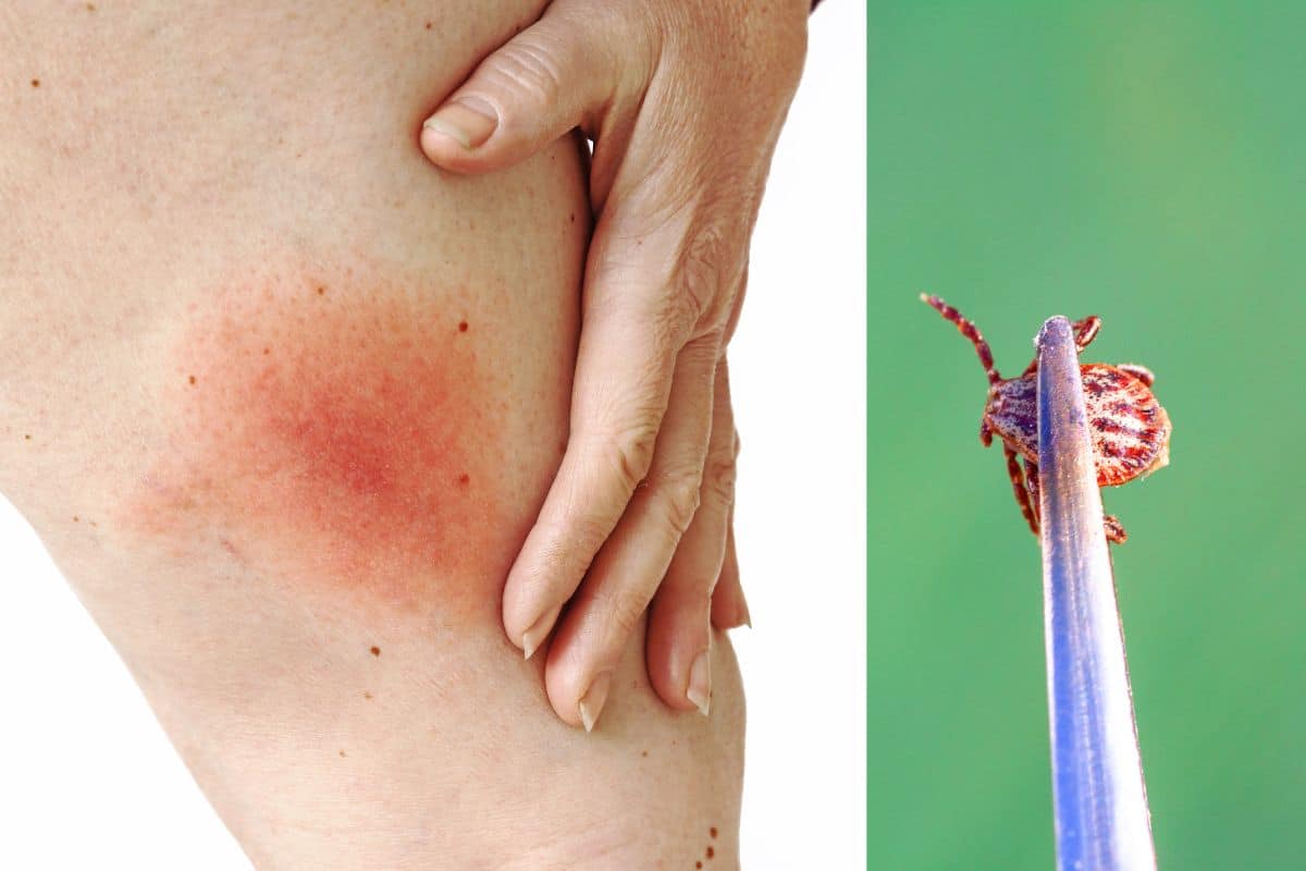 Quais são os sintomas da doença de Lyme, que atinge Justin Bieber? Entenda 3 sintomas da doença de lyme