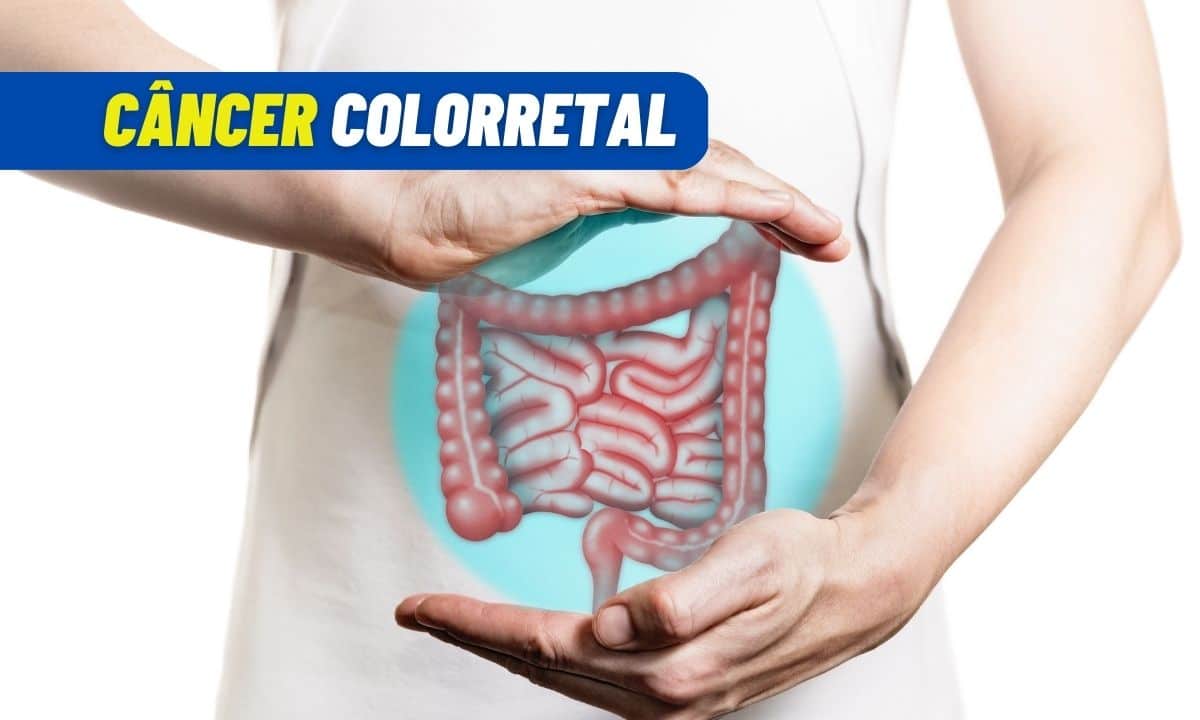 Câncer colorretal é o segundo que mais mata no mundo 1 Câncer colorretal.