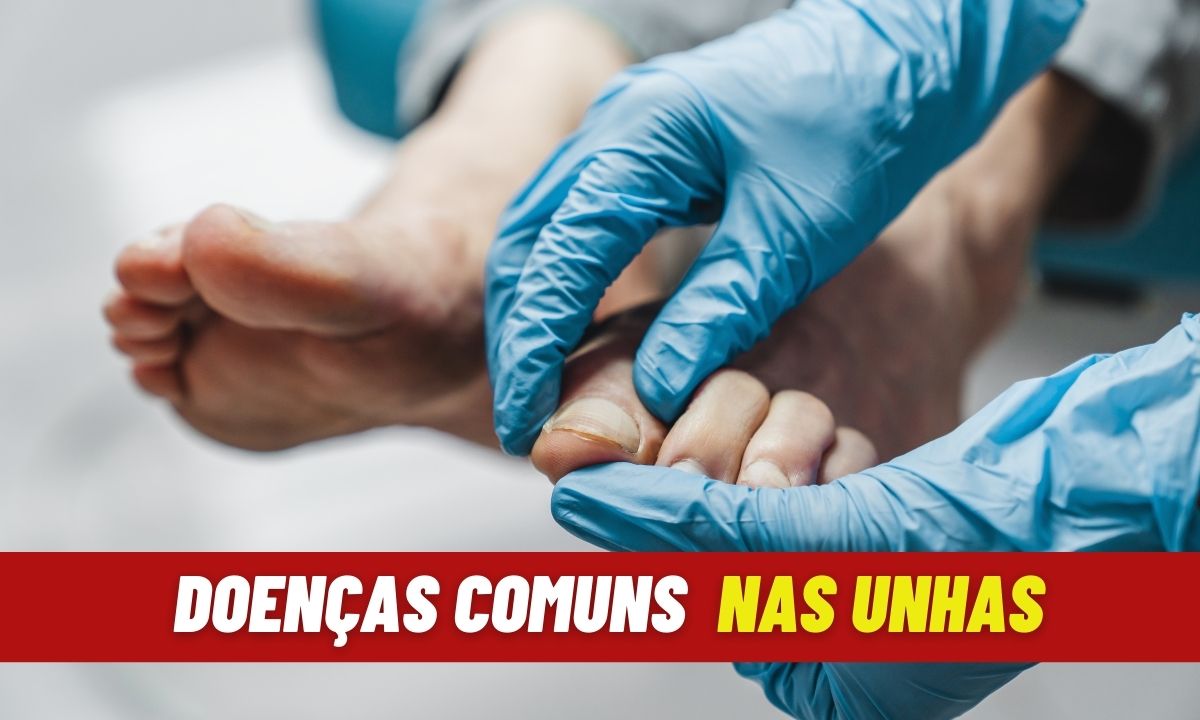 Conheça 7 doenças de unhas mais comuns e como evitá-las 1 Doenças Comuns nas Unhas.