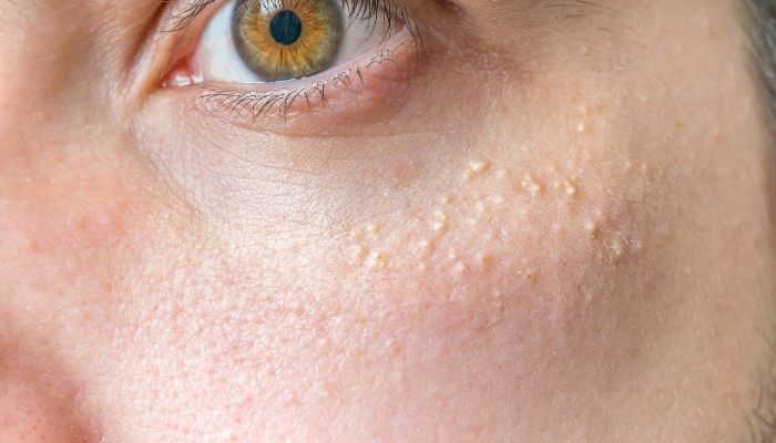 O que causa Milium na pele? É sinal de problemas de saúde? Entenda 2 Milium