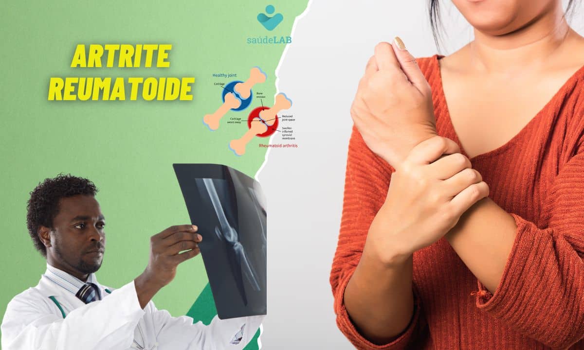 Quais são os sintomas da artrite reumatoide? Entenda mais sobre a doença 1 Artrite reumatoide.