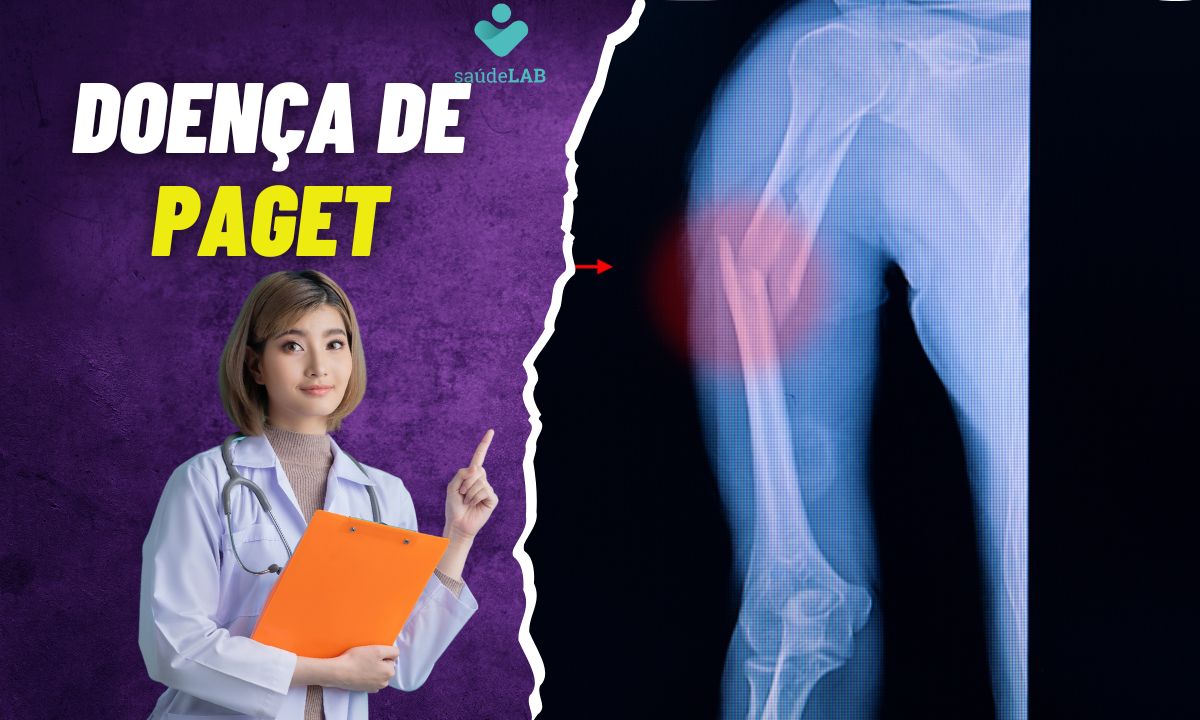 Doença de Paget: conheça os principais sinais e sintomas da doença 1 Doença de Paget.