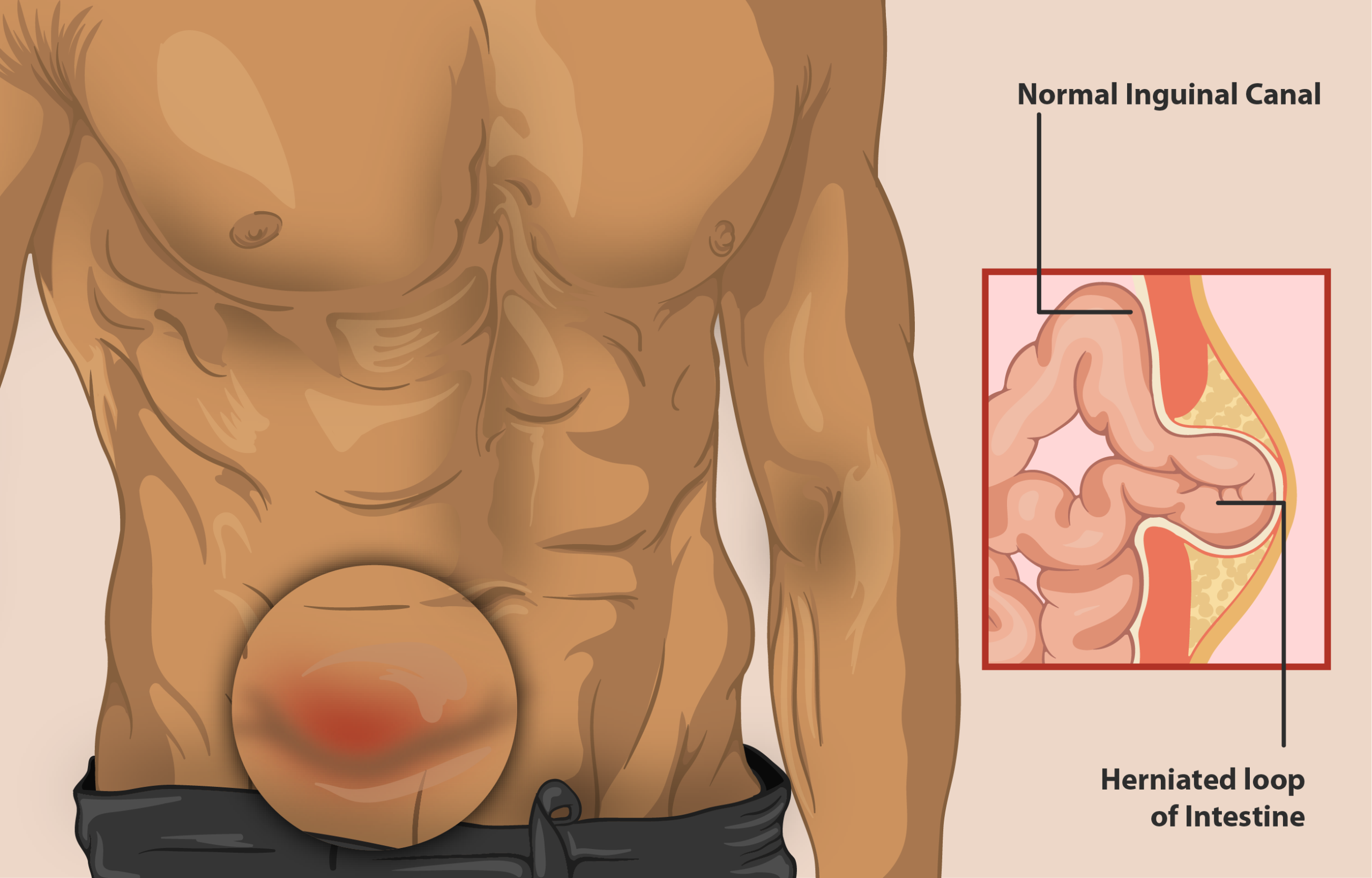 Hérnia Inguinal: quais são as causas? Entenda tudo sobre o problema de saúde 2 Hérnia Inguinal.