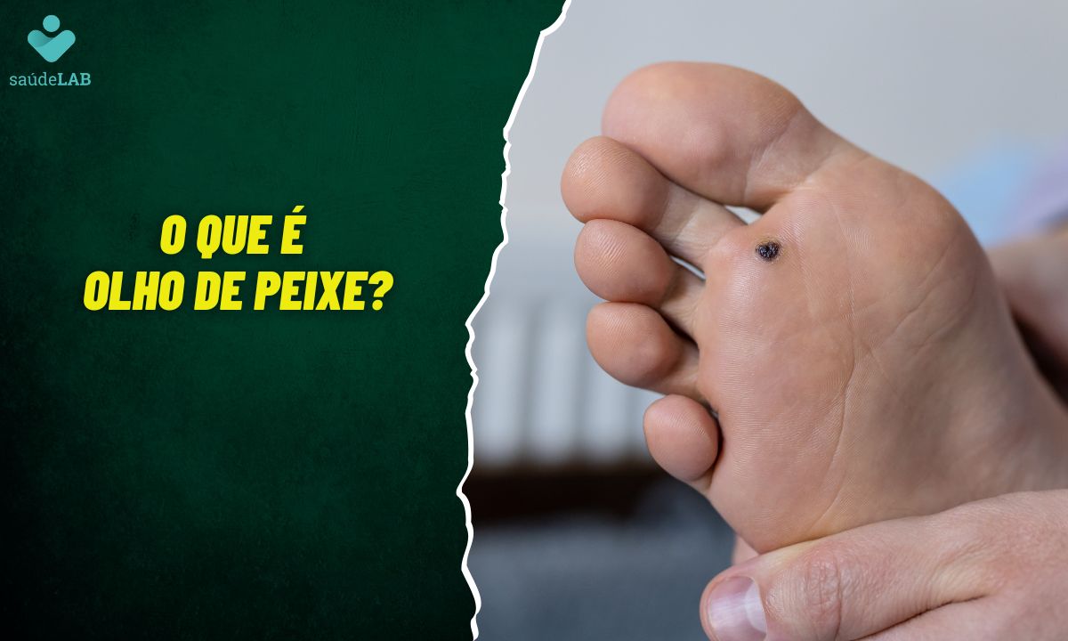 Olho de peixe: saiba o que é, as causas e o tratamento da verruga plantar 1 O que é verruga plantar ou olho de peixe.
