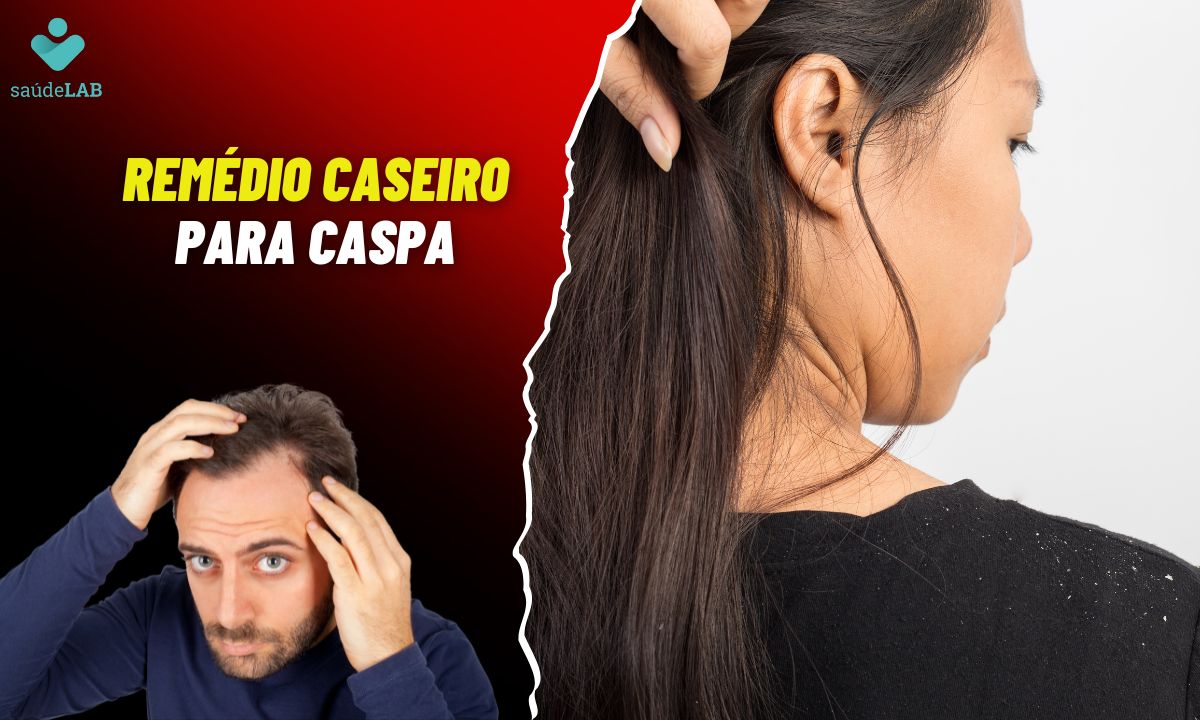 Remédio Caseiro para Caspa: saiba como resolver o problema de maneira simples 1 Remédio caseiro para caspa.