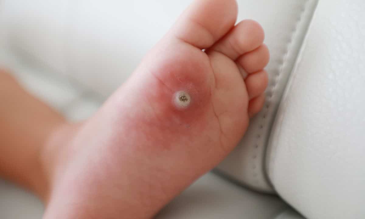 Tungíase ou Bicho de Pé: saiba as causas, como tirar e as complicações da doença 2 Bicho de pé ou tungíase.