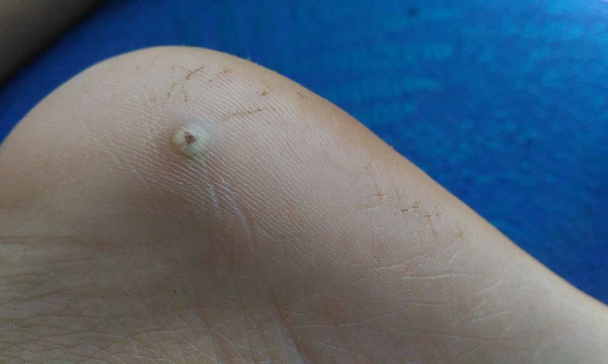 Tungíase ou Bicho de Pé: saiba as causas, como tirar e as complicações da doença 1 Bicho de pé ou Tungíase.