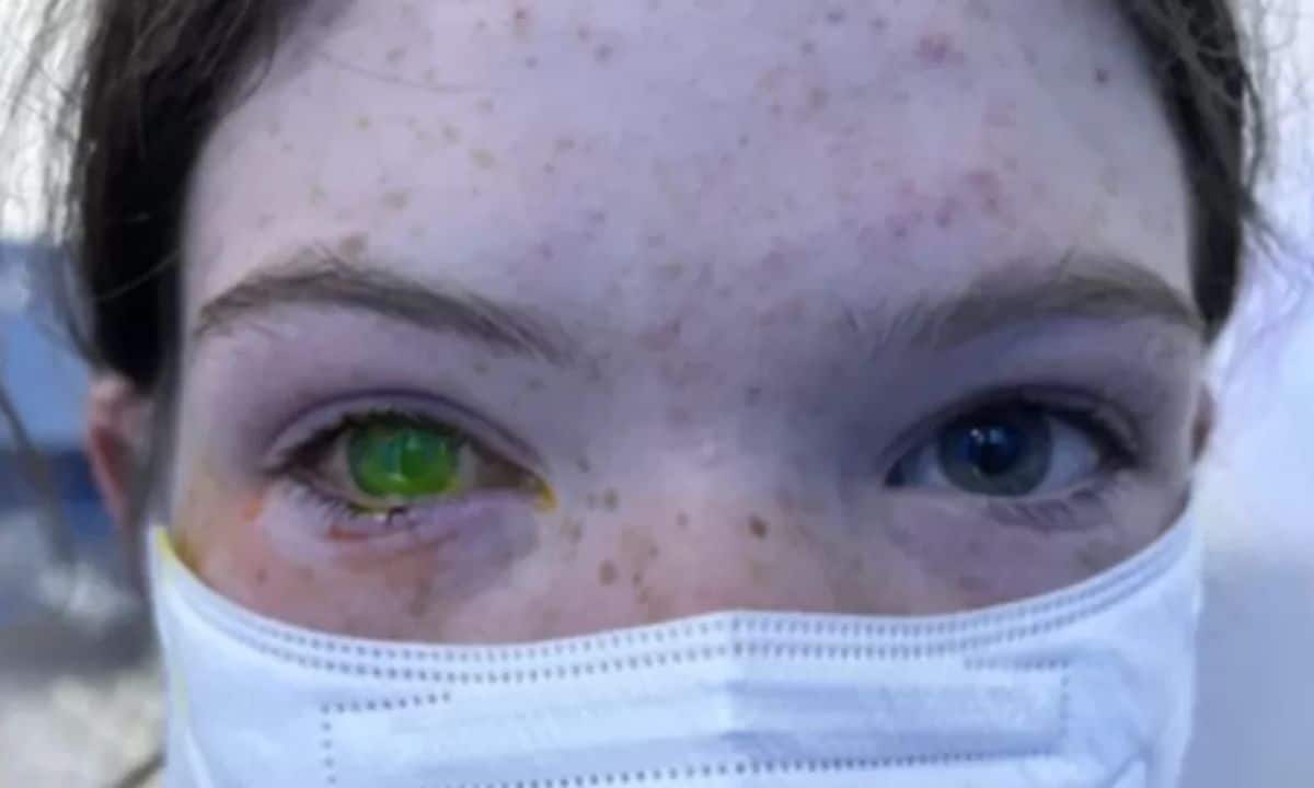 Doença que deixa olhos esverdeados e causa dor intensa deixa população em alerta 1 Doença do olho esverdeado.