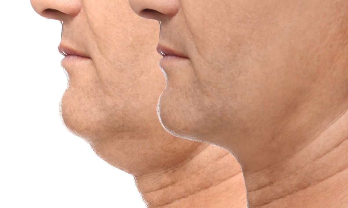 A papada está incomodando? Conheça as formar de rejuvenescer o pescoço 1 Papada.