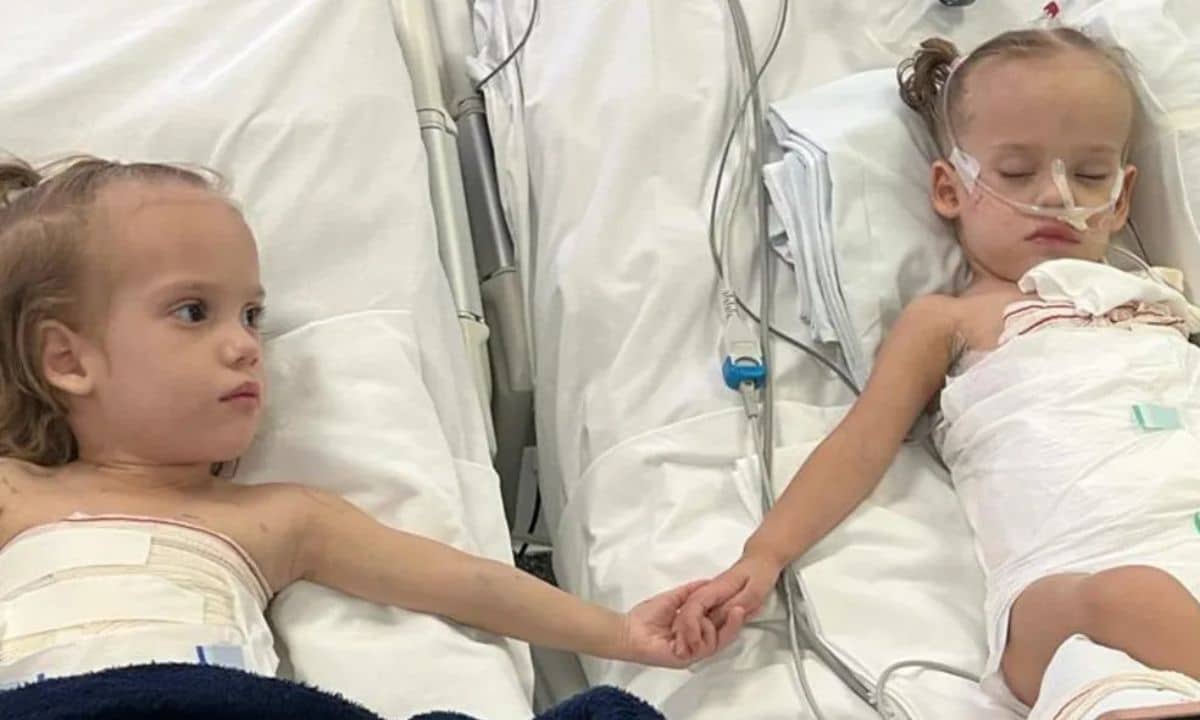 Gêmeas Siamesas separadas em Goiânia recebem alta após 51 dias da cirurgia 2 Gêmeas Siamesas.