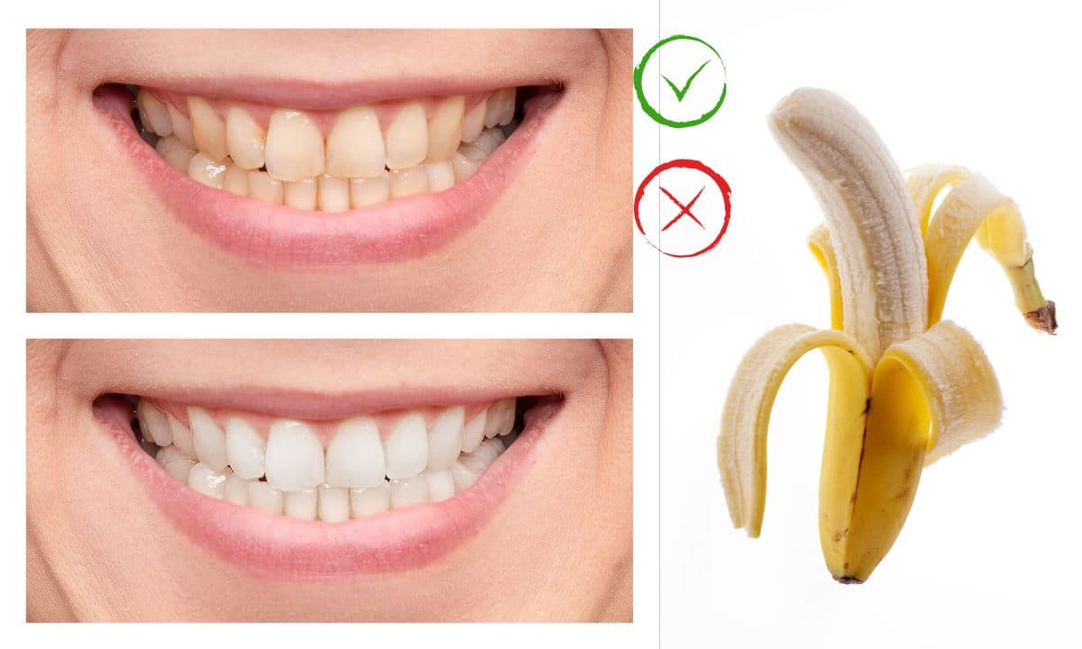 Casca de banana clareia os dentes? Descubra se é mito ou verdade 1 Casca de banana clareia os dentes?
