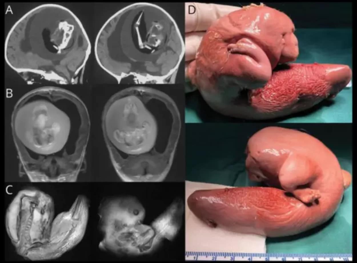Bebê de 1 ano realiza cirurgia para retirar feto de irmão gêmeo do cérebro (FOTO) 2 Bebê de 1 ano realiza cirurgia para retirar cérebro feto de irmão gêmeo