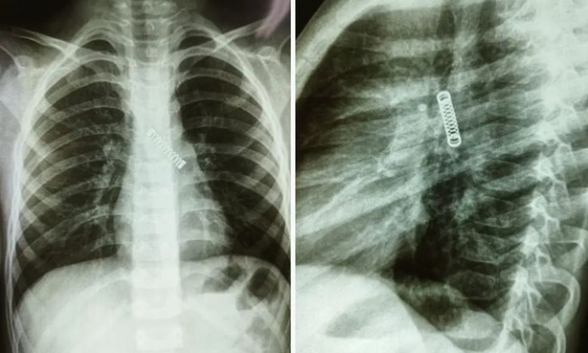 Após tosse persistente, mãe descobre que filho de 5 anos tinha objeto estranho dentro do pulmão 2 Menino com mola no pulmão
