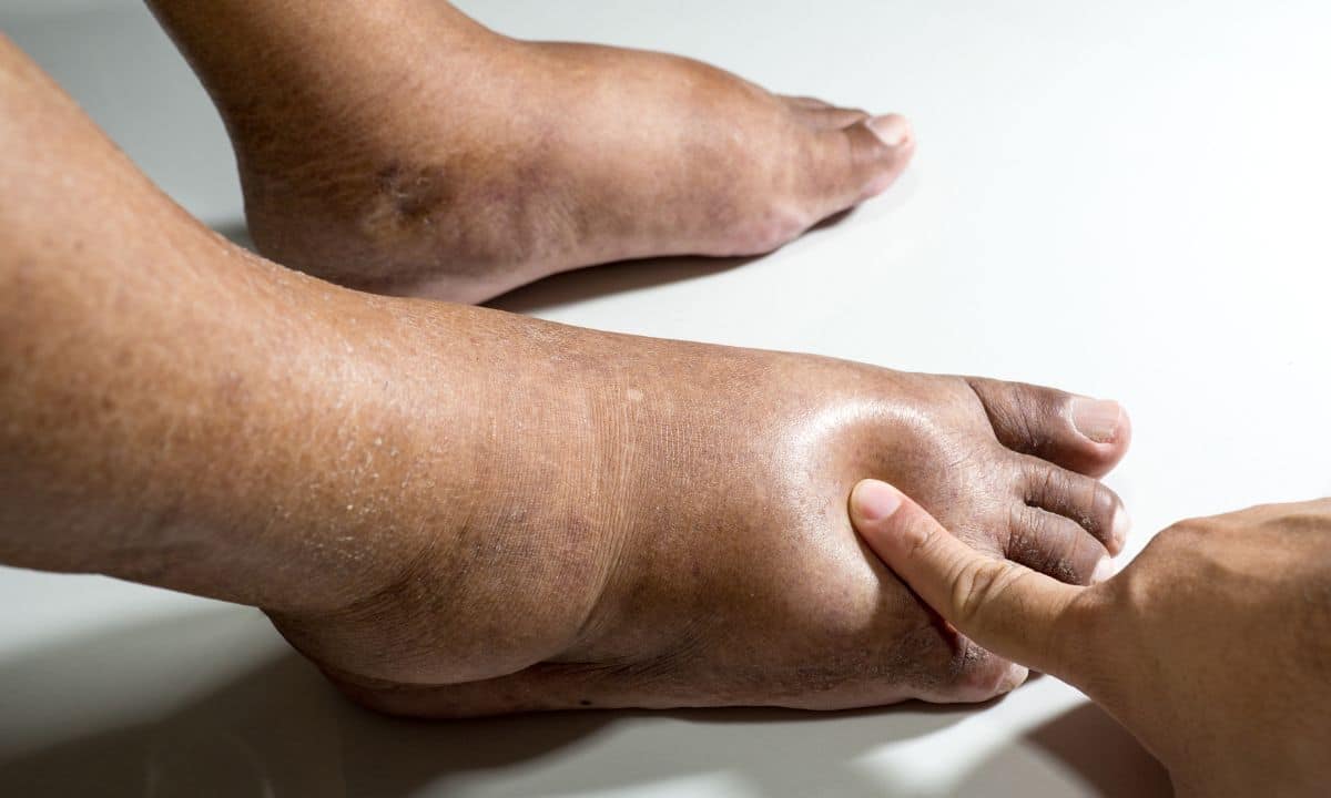 Pés inchados? Saiba quais são as principais causas e formas de solucionar 1 Pés inchados.