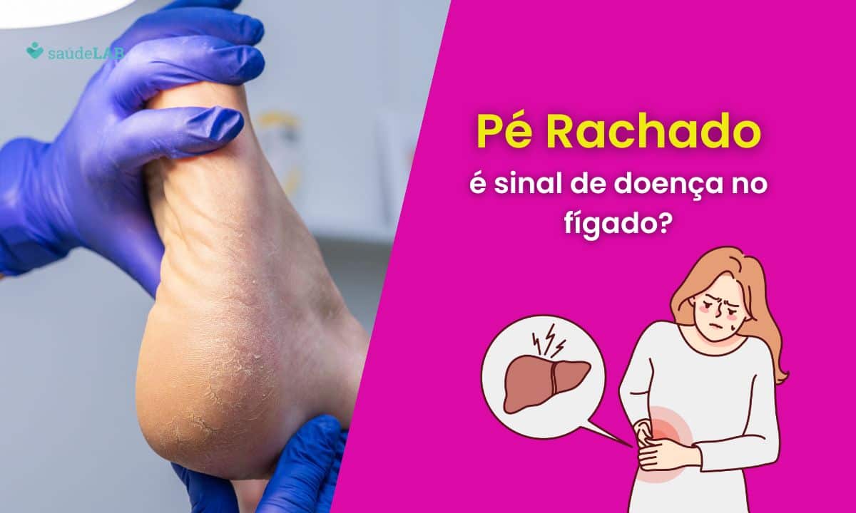 Pé rachado e problema no fígado: existe alguma relação entre eles? 1 Pé rachado e problema no fígado.