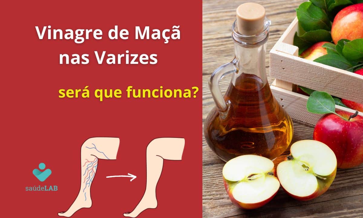 Remédio caseiro para varizes com vinagre de maçã: será que funciona? Entenda! 1 Remédio Caseiro com Vinagre de maçã para varizes.